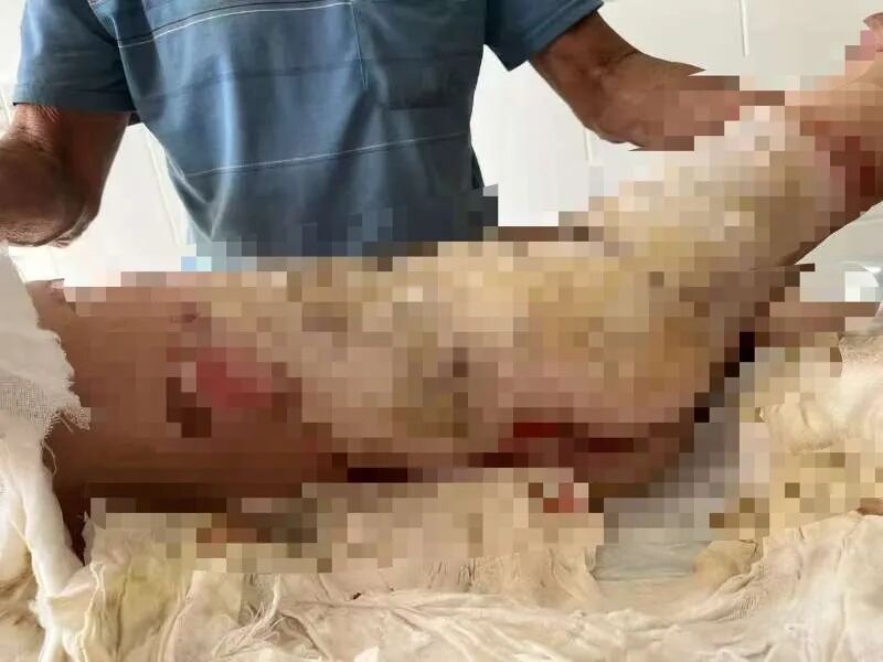 女童被烧伤送医  家陷困境盼援手