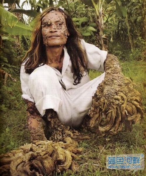 印尼树人 临床图片