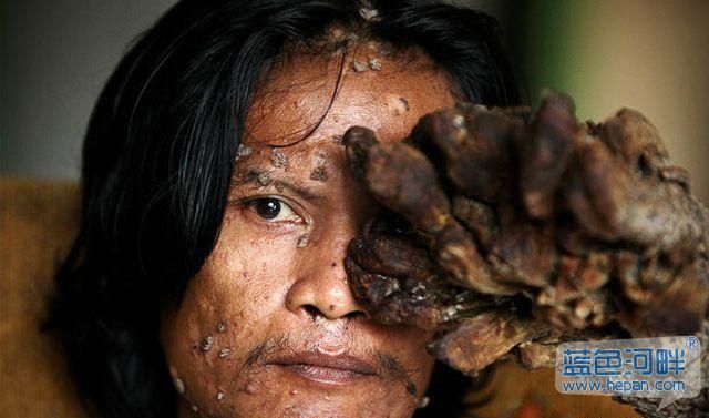 印尼树人患人体乳头状瘤病毒,现代医学无法根治!恐怖啊~